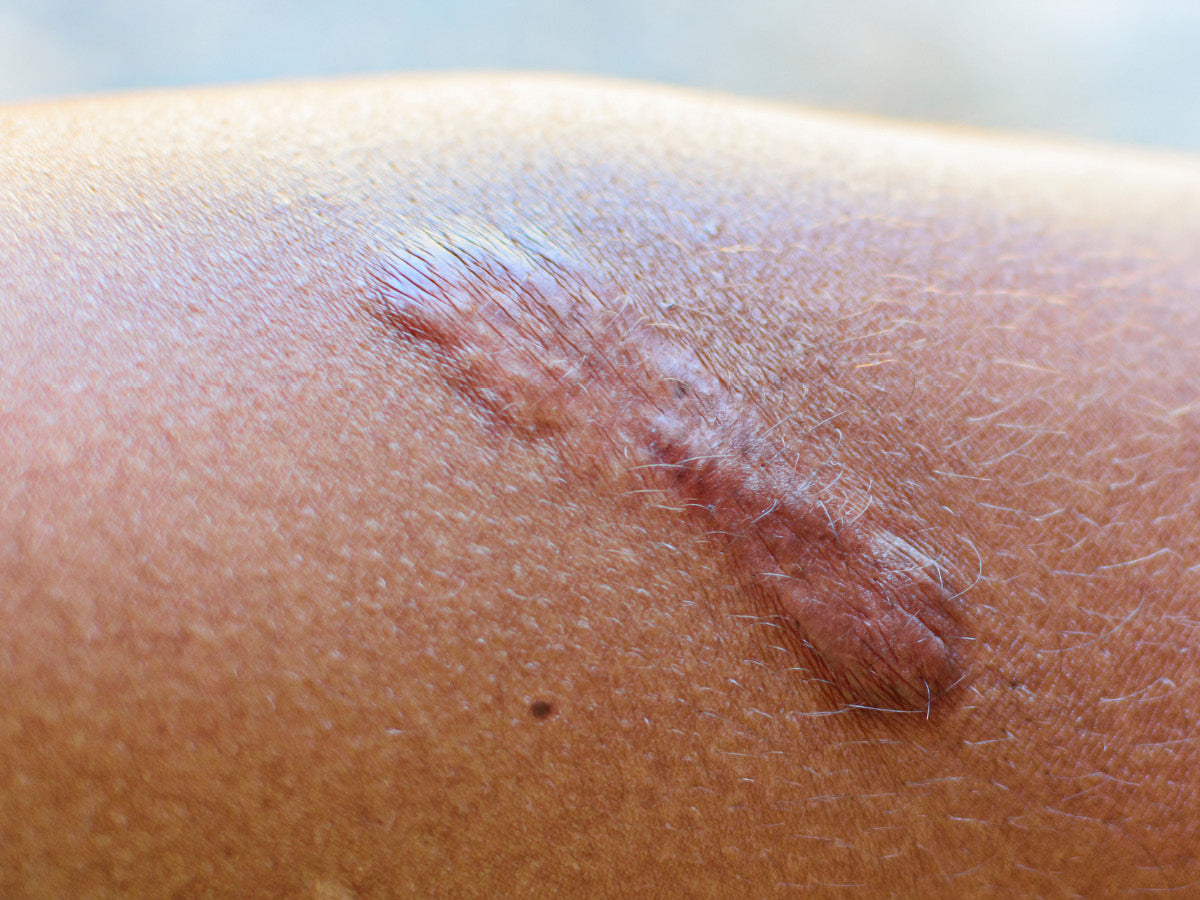 Image of Narbenbehandlung pro Stunde